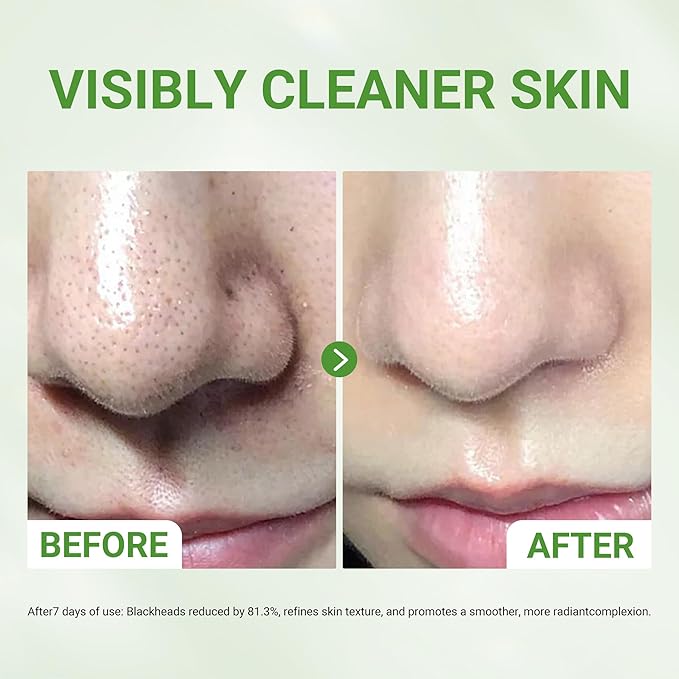 3X Acid Clay Mask with Amazonian White & Glacier Clay, Deep Cleansing Facial Skincare for Pore Minimizing Oil Control & Detox, Face Mask for All Skin Types, 3.53 oz