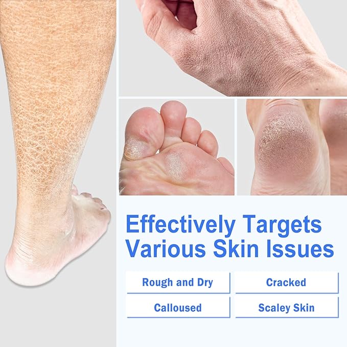 TEAWOO Ultra-Hydrating Foot Cream for Dry Cracked Heels and Feet, Pair with Silicone Socks for Cracked Heel Treatment, Silicone Socks Included (Urea Conc. 40.67%, 5.29 OZ/150g)