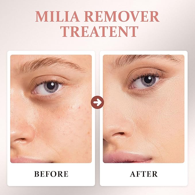 Milia Remover Serum –Action Salicylic Acid Serum for Under-Eye & Face, Oil-Free Clarifying Essence for Smooth Skin, Gentle Formula for Milia Remover & Brighter Complexion