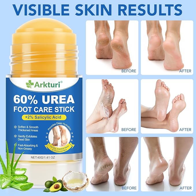 Urea Cream 60% with Salicylic Acid 2% Urea Foot Care Stick, Foot Cream for Dry Cracked Feet, Heels, Knees, Hands, Elbows, Feet Moisturizer Stick for Callus Remover & Skin Softener (40g (Pack of 1))
