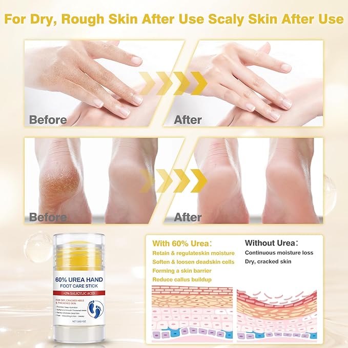 60% Urea Cream with 2% Salicylic Acid Foot Balm, Portable Hand Cream, Foot Cream for Dry Cracked Heels and Feet Hand, Urea Heel Care Stick Callus Remover & Skin Softener, 1oz*2