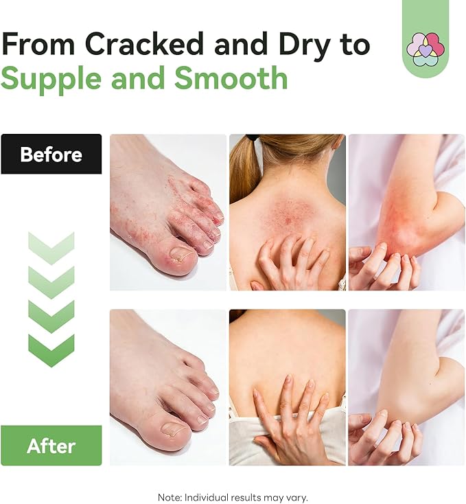 SAVILAND Antifungal Cream 120g Extra Strength: Max 25% Undecylenic Acid Fungal Cream for Skin Athletes Foot Jock Itch Ringworm Foot Fungus Treatment Natural Skin Relief with Tea Tree & Oregano Oil