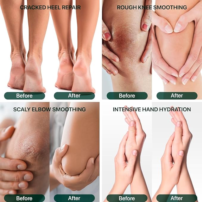 Urea Cream 40 Percent with Salicylic Acid 2% - Maximum Strength Callus Softener - Advanced Hand & Foot Moisturizer for Dry Cracked Heels, Knees, Elbows, Corns & Thick Skin