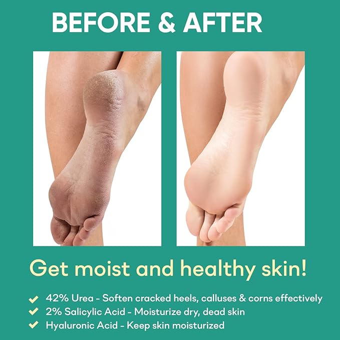 42% Urea Gel - Max Plus Salicylic & Hyaluronic Acid cracked heel repair callus remover for Elbows, Feet, and Hands, and cracked heel, calloused feet remover gel 4oz