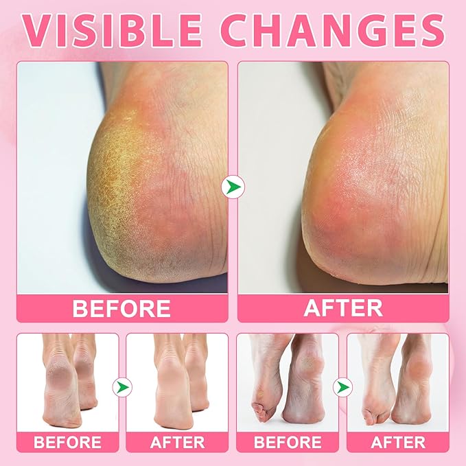Cracked Heel Urea Stick,Peach Scent,Foot Care Cream 60 Percent Stick,Maximum Strength Urea Cream for Feet,Moisturizer and Hydrates Dry Cracked Feet, Knees, Elbows, Hands