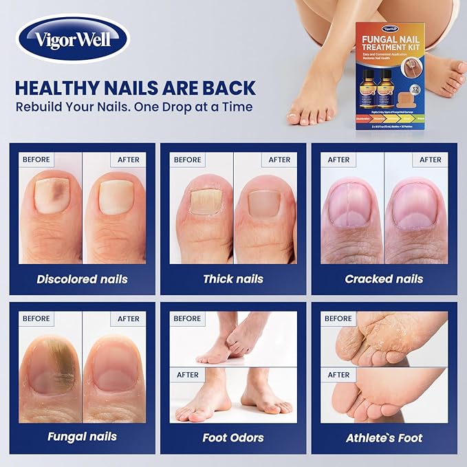 Toenail Treatment Extra Strength: Dual Action Nail Repair Kit for Thick, Brittle or Discolored Nails - 30 ml Nail Repair Gel with 25% Undecylenic Acid - (Medium) 32 Nail Patches