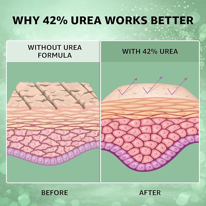 42% Urea Cream MAX with Tea Tree Oil & Aloe Vera - Maximum Strength Formula for Cracked Heels, Thick Calluses & Dry Rough Skin - Fast Absorbing Moisturizer for Feet, Heels, & Dry Cracked Skin - 4oz