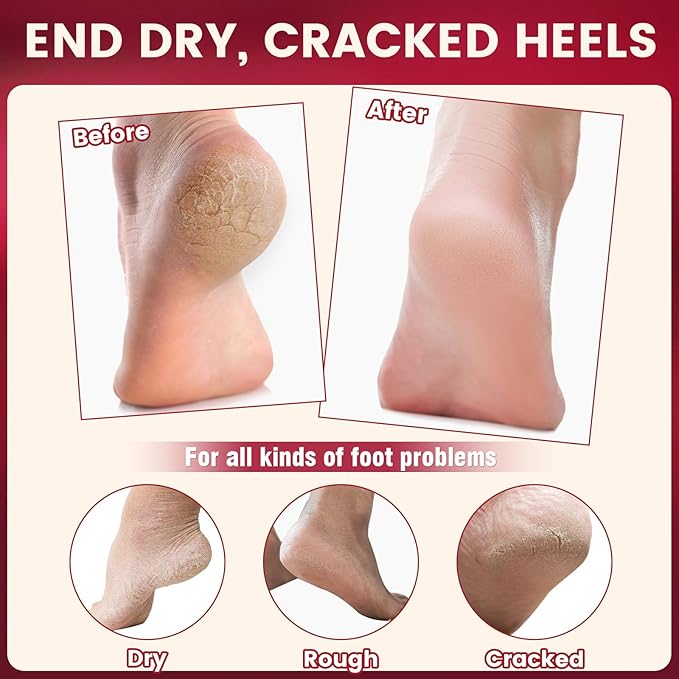 TEAWOO 5Pcs Cracked Heel Treatment & Repair Stick – Rose Oil Infused cracked heel stick Balm for Dry, Cracked Heels – No-Mess Applicator, Travel-Friendly