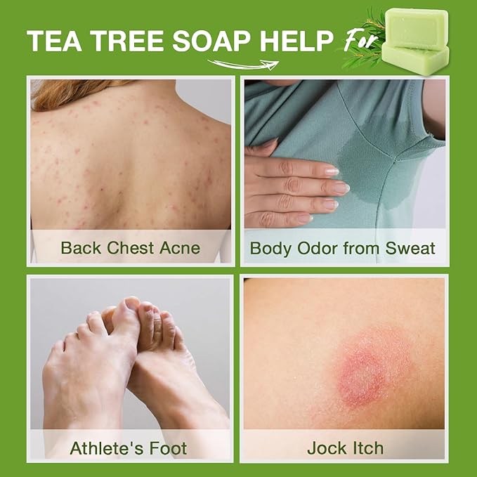 PHARMBANNER Tea Tree Antifungal Soap Bar: Body Wash for Face & Body Acne, Folliculitis, Jock Itch, Ringworm, Athlete’s Foot, Body Odor, Eczema – 2×4.1 oz