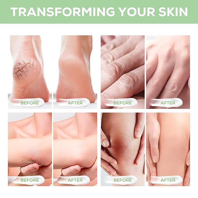 Urea Cream 40%, with 2% Salicylic Acid 4.23 oz, Powerful Softening of Cracked Heels, Quick Absorption, Urea Foot Cream for Dry Heels, Hands, Feet, Knees & Elbows