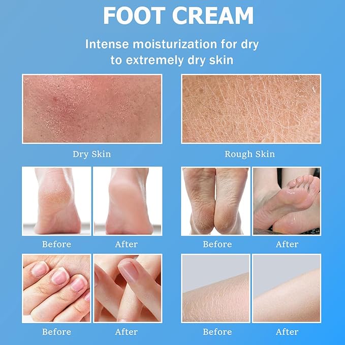 Urea Cream 60% - Urea Foot Cream with Moisturizing Heel Socks for Dry Cracked Hands Heels, 60 Percent for Feet Maximum Strength with 2% Salicylic Acid, Jojoba Oil, Aloe Vera, 5.31oz (Blue, 5.3oz)