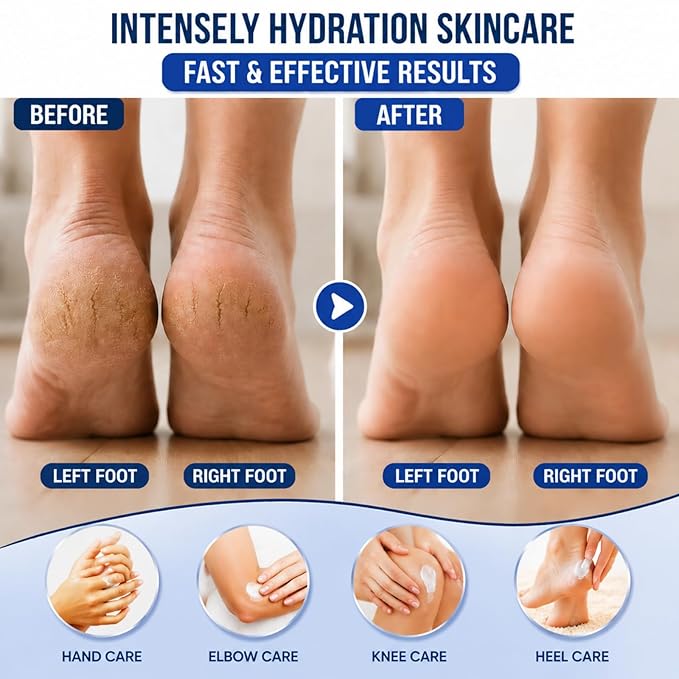 Urea Cream 40 Percent for Feet Maximum Strength, Urea Cream 40% Plus Salicylic Acid 2% for Rough, Dry, Thick & Cracked Skin, Deep Hydration, 5.29 Oz, Non-Greasy (5.29 Oz)