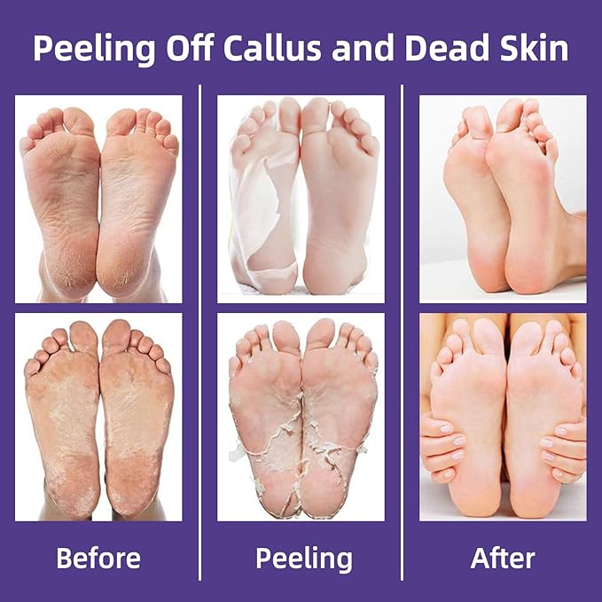 Hydrating Foot Masks Set,Exofliating 6 Pack Socks Mask for Dry Feet Peeling Away Dead Skin Calluses（Lavender）