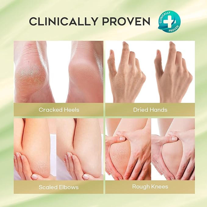 Urea Cream 42% Foot Cream Salicylic Acid 4 Oz, Upgraded Callus Remover For Feet, Knees& Elbows, Intensive Moisturizes & Softens Skin, Exfoliates Dead Skin
