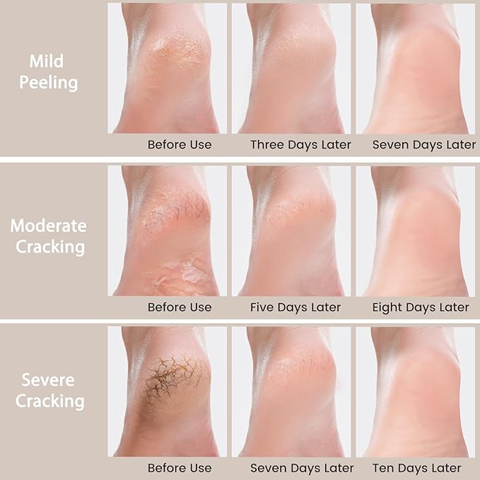 Urea Cream 40 Percent - Foot & Hand Cream for Dry, Cracked Heels, Feet, Knees, Elbows, and Hands - Maximum Strength Urea Lotion for Softening and Moisturizing