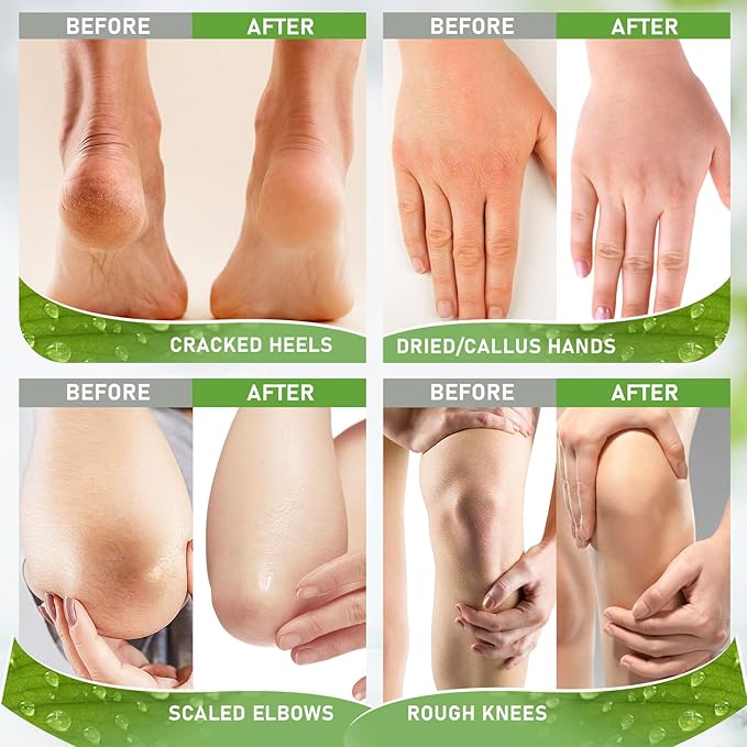 Urea Cream 42% - 2% Salicylic Acid Foot Moisturizer - Callus & Dead Skin Remover, Repairing Foot File, 3.5 oz