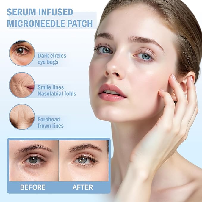 Dissolvable Microneedle Eye Patches for Dark Circles | 1 Pair | Under Eye Mask with Hyaluronic Acid & Retinol | Needle-Free Treatment for Puffiness & Fine Lines