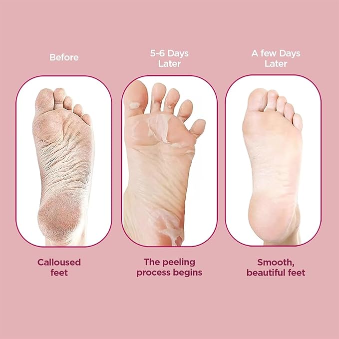 FURR By Pee Safe Peeling & Exfoliating Foot Mask | Reduces Dry Skin & Hard Calluses | Exfoliates, Moisturizes & Hydrates Feet | Nourishing Foot Mask | Fits Like Socks | For Soft & Smooth Skin | Unisex