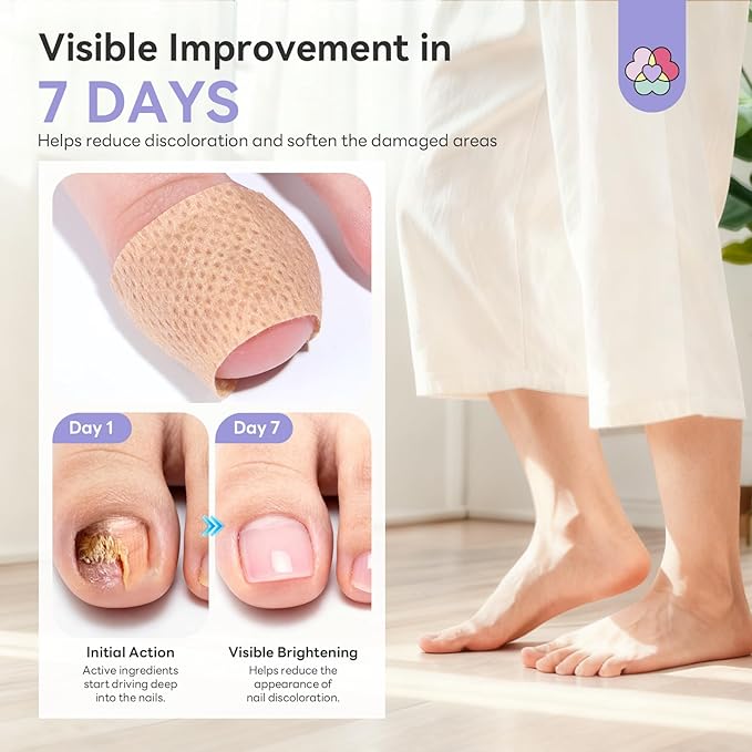 SAVILAND Extra Strength Fungal Nail Patches FSA-HSA: 64 Patch Overnight Repair 1% Tolnaftate Toenail Treatment Nighttime Nail Renewal Restores Damaged Nails Discolored Thick Yellow