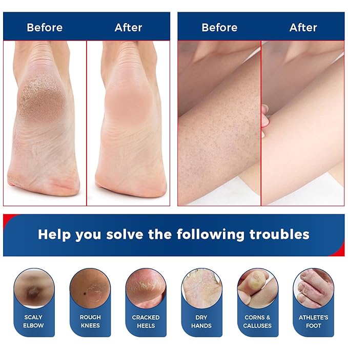OUKEYA NEW FORMULA Urea Cream 40% Plus 2% Salicylic Acid for Feet Maximum Strength, Dry Cracked Hand Heel Moisturizing Repair Lotion for Knees, Elbows, Removes Corns, Dead Skin Cream, 5.29 oz 2 Pack