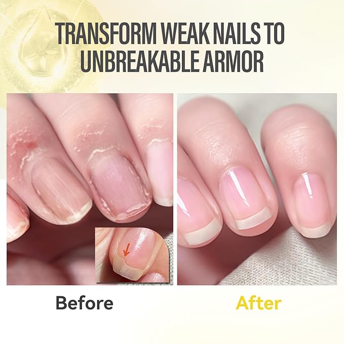 CHUCHU Nail Growth and Strengthener Oil for Cuticle - Repair Moisturizing Treatment - Natural Jojoba Vitamin B & E Nail Oil for Dry Cracked Nails (Pineapple)