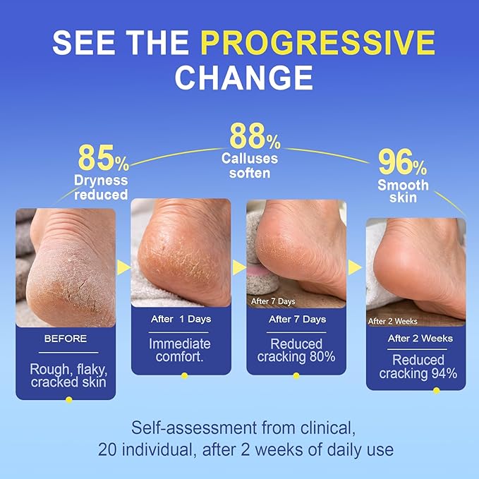 Urea Cream for Feet Cracked Moisturizing: 24H Moisture Maximum Strength Formula for Cracked Heels & Hands - Enriched with 40% Urea Beef Tallow & Salicylic Acid Fast Absorbing - 5 OZ