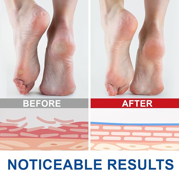 Urea Cream Stick, Maximum Strength Urea Foot Cream for Dry Cracked Feet, Knees, Hands, Exfoliating Dead Skin,Foot Care Cream Moisturizer 2 Pack