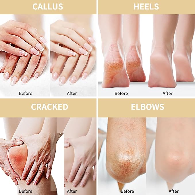 Urea Cream 50 Percent for Feet 10.58 oz with Oat and 2% Salicylic Acid, Foot & Hand Cream included Hyaluronic Acid, Tea Tree and Aloe Vera for Deep Moisturizing, Callus Removing (Classic Formula)