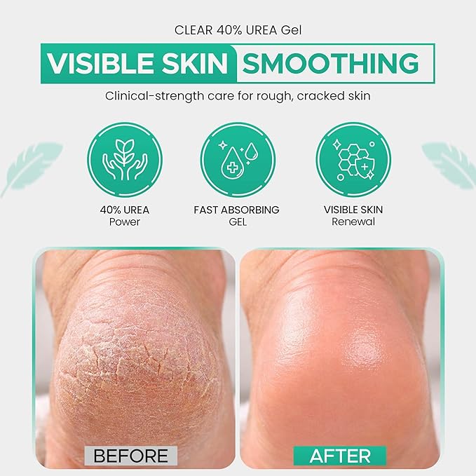 CLEAR 40 Urea Gel 40% (8 oz) with Tea Tree & Coconut Oil, Aloe Vera – Intensive Moisturizing & Exfoliating Gel for Dry Rough Skin, Feet, Heels, Elbows, Hands & Nails – Superior Hydration