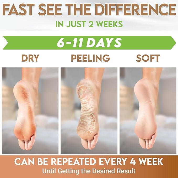 karma organic Feet Peeling Masks for Dry Cracked Feet, Remove Dead Skin & Calluses - Removes & Repairs Rough Heels, Dry Toe Skin (Pack of 2)
