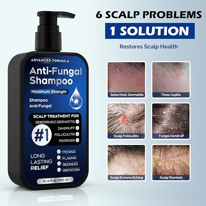 Antifungal Psoriasis Shampoo for Seborrheic Dermatitis, Folliculitis & Scalp Psoriasis, Anti-Dandruff Shampoo for Men & Women, Relieves Scalp Itching, Dryness, Sulfate & Paraben-Free, 10.1 Fl Oz-Fresh