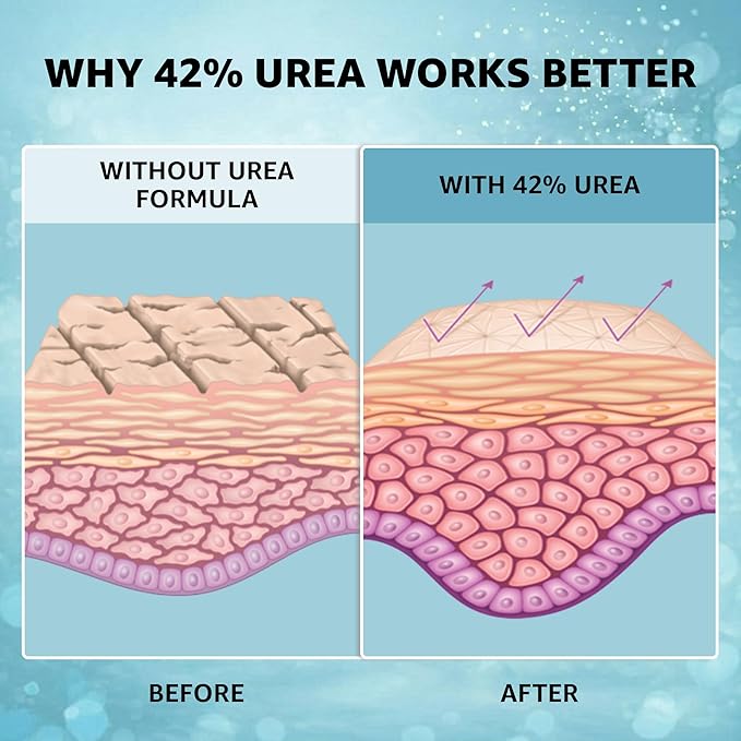 42% Urea Cream PLUS with 2% Salicylic Acid | High Strength Formula for Cracked Heels, Thick Calluses & Dry Rough Skin | Quick Absorbing Low Crystallization Hydrating Foot Moisturizer – 4 Oz