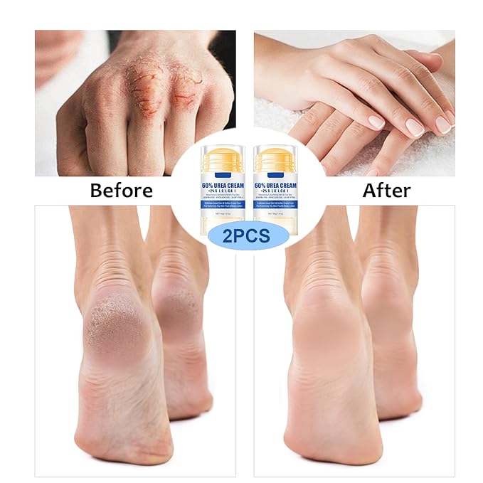 60% Urea Foot Cream Stick - Foot Care Balm Moisturizer for Dry Cracked Feet Hands Knees Elbows Hands Maximum Strength - 2Pcs Moisturizing Heel Balm Hydrates Calluses Remover Rough Skin Softener 1.41oz