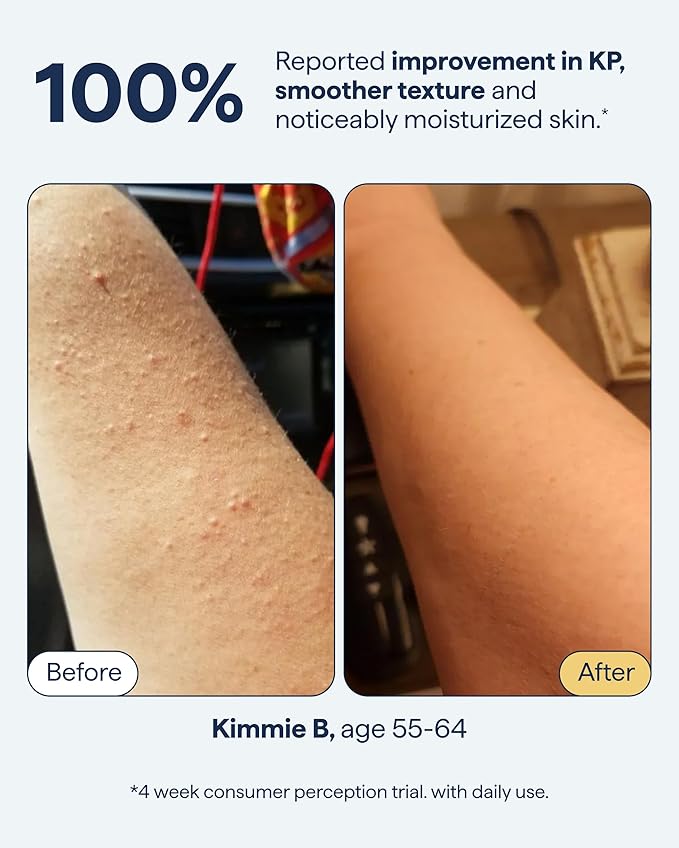Remedy KP Body Moisturizer | Keratosis Pilaris and Chicken Skin Treatment with Retinol, Urea, Lactic Acid and Ceramides | Exfoliating and Moisturizing Lotion | By Dermatologist Dr. Shah, 7.7 fl oz