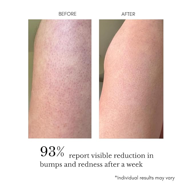 KP Treatment Serum - Triple Acid Complex (AHA + BHA + PHA) for Keratosis Pilaris | Gentle Daily Body Serum for Rough Bumpy Skin, Strawberry Legs & Ingrown Hairs | 4 fl oz
