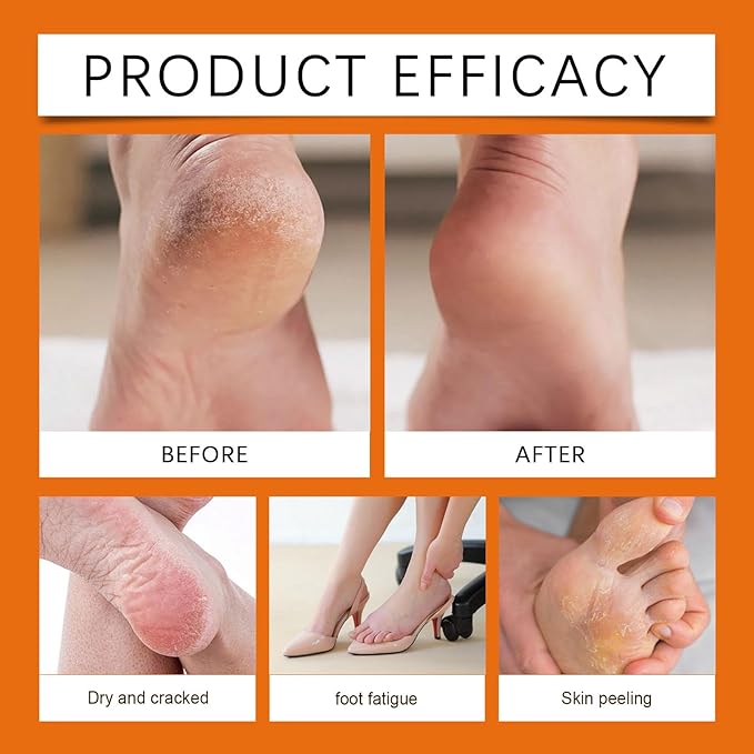 NovaCharm 2PCS Urea Cream 60 Percent for Feet, Maximum Strength Urea Foot Cream Stick, Foot Moisturizer Lotion for Cracked Heels, Dry Hands & Rough Knees (1.4Ounce(Pack of 2), Honey)