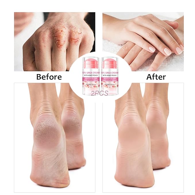 10% Foot Urea Cream for Feet Hand Care - 2Pcs Heel Stick for Cracked Feet Dry Rough Heels, Hands, Elbow and Knees - Moisturizing Urea Foot Stick Balm Intensive Moisturizer for Dead Skin , 1.41oz
