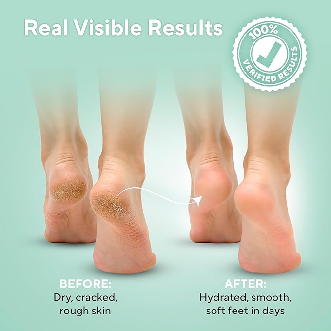 Peeling Foot Mask that Remove Dead Skin and 40% Urea Cream with Maximum Strength Moisturizing