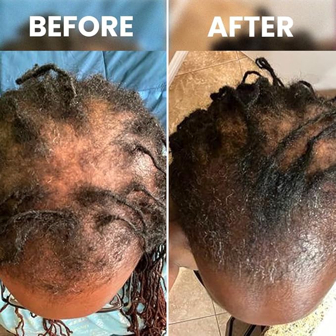 Rennora Hair Growth Serum with Organic Herbs and Natural Vitamins, Peppermint Oil, Stinging Nettle, and Rosemary Oil, No Chemicals, Formulated for Hair Regrowth (6 Pack - 180 Day Supply)