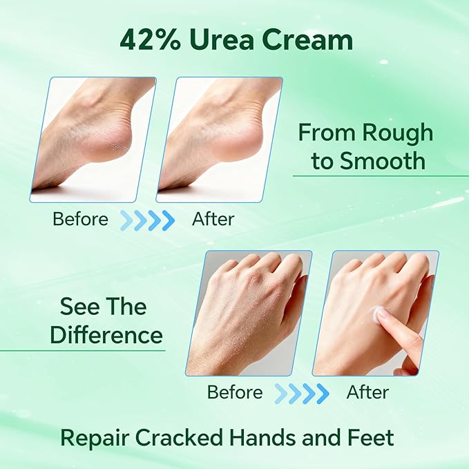 Professional 42% Urea Cream for Feet, Intense Moisturizer for Extremely Dry, Cracked Heels & Rough Skin, Callus Remover, Foot Softener Treatment, Safe Cracked Heel Repair
