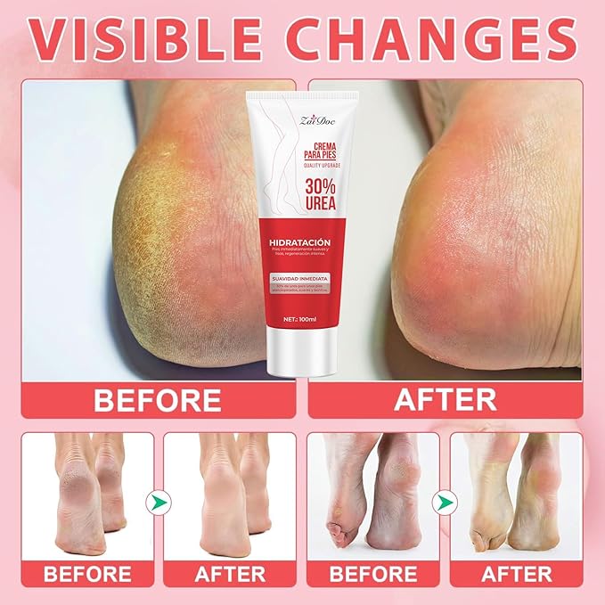 2Packs Foot Cream&Urea Cream 30 Percent for Feet, Foot Cream and Hand Cream Maximum Strength with Hyaluronic Acid, Aloe Vera for Deep Moisturizes, Callus Remover