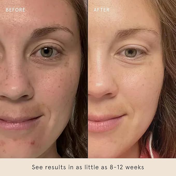 Barefaced Brightening Serum Dark Spot Corrector | Kojic Acid, Arbutin, Azelaic Acid & Licorice | Anti-Aging, Hydrating | Antioxidant-Powered Formula Fades Hyperpigmentation & Evens Skin Tone (1 Oz)