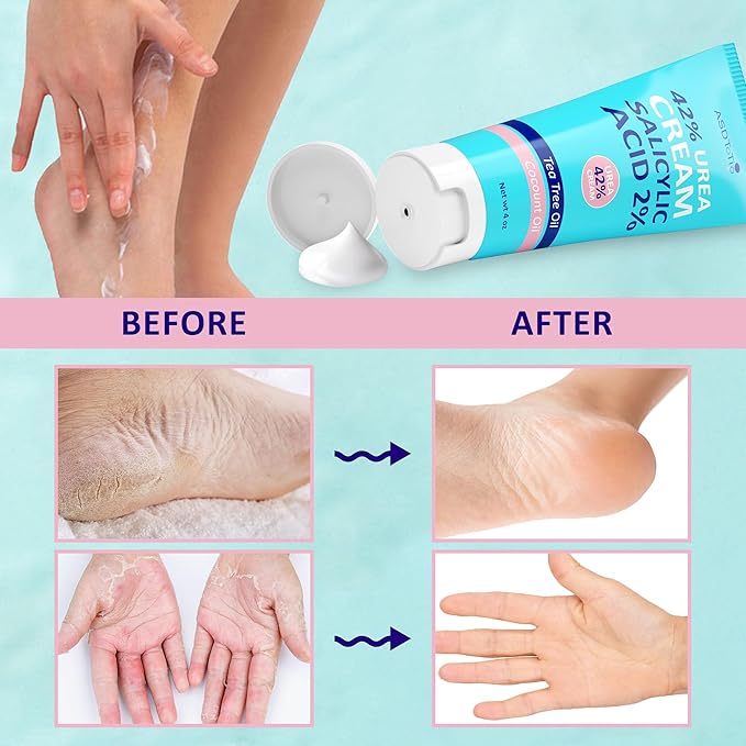 ASDToTio Urea Cream 42% - Foot Care for Dry Cracked Heels, Foot Lotion - With 2% Salicylic Acid, Tea Tree Oil, Shea Butter, Aloe Vera - For Feet, Hands, Heels, Elbows, Knees and More - 4 oz