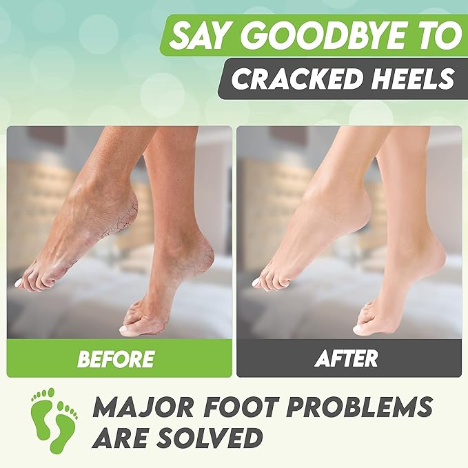 Foot Peel Mask Green Tea Moisturizing Exfoliating Foot Masks - Karma Organic Feet Peeling Masks for Dry ed Feet, Remove Dead Skin & Calluses - Removes & Repairs Rough Heels, Dry Toe Skin (Pack of 2)