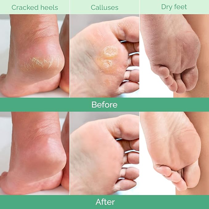 PLANTIFIQUE Foot Peeling Mask - Peeling Foot Mask Dermatologically Tested Repairs Heels & Removes Dry Dead Skin for Baby Soft Feet (Jasmine, 1 Count (Pack of 2))