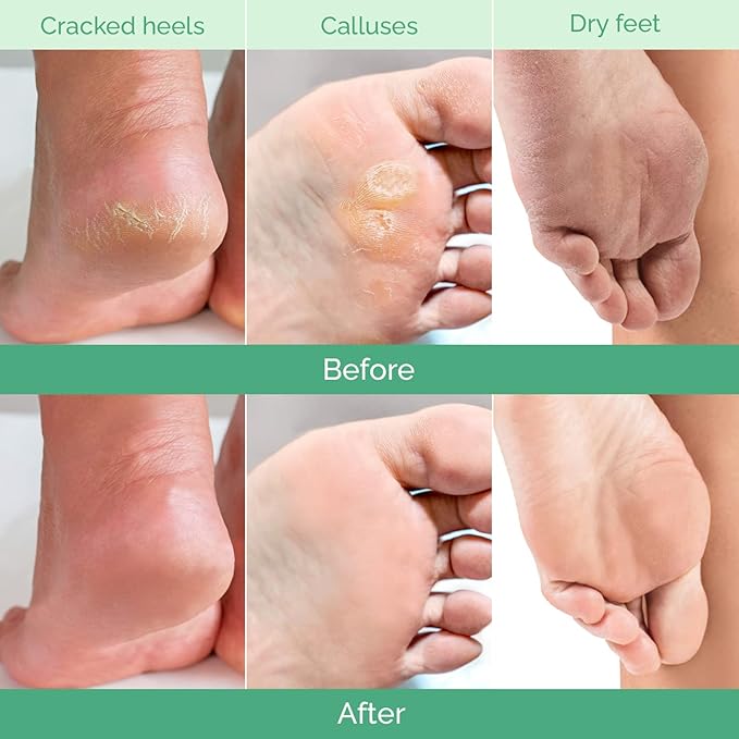 PLANTIFIQUE Foot Peeling Mask 2 Pack Peach and Korean Foot Mask with Shea Butter 4 Pairs box for Dry & Cracked Feet