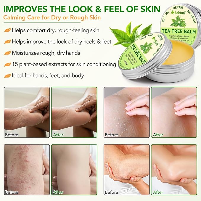 Tea Tree Oil Balm, Tea Tree Oil for Skin, Tea Tree Oil Balm for Dry Skin Relief - Irritated Skin, Cracked Heels - Organic & Safe for All Ages (1 Pack)
