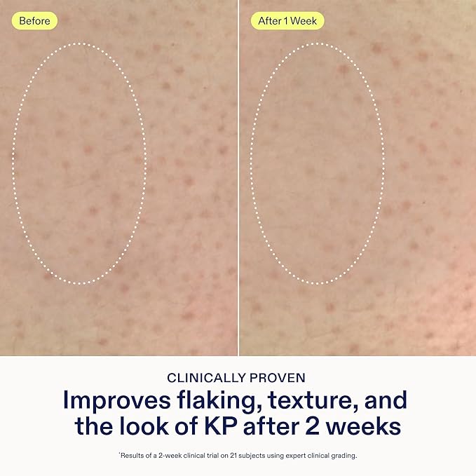 Skinfix KP + PsO Smoothing Body Treatment - 5.07 oz - Clinical-Grade Lactic Acid Smoothing Treatment for Keratosis Pilaris- and Psoriasis-Prone Skin - Safe for Sensitive Skin - Vegan, Cruelty Free