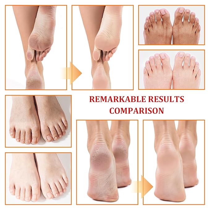 Foot Peeling Spray Oil,Moisturizing Nourishing Foot Exfoliating Peeling Spray,Instantly Hydrating Gently Foot Peel Off Spray for Removing Dead Skin & Calluses（Orange）