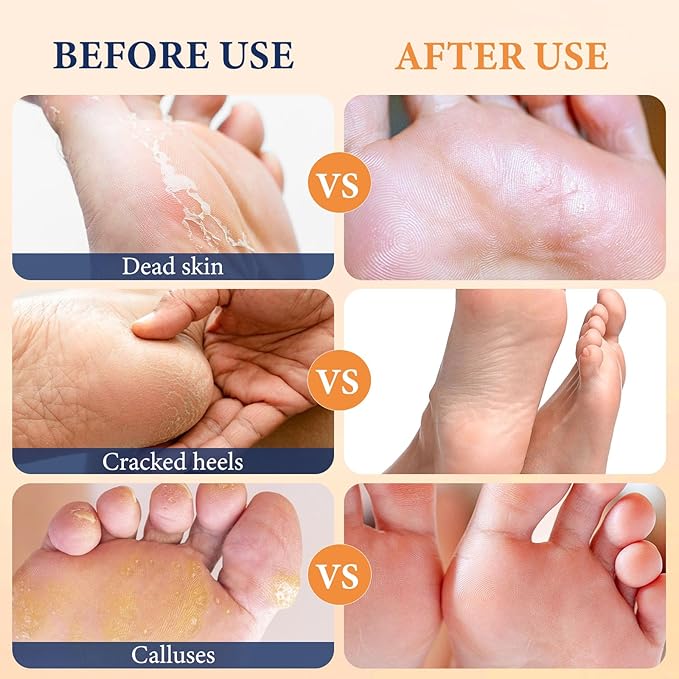 Z:SEA Foot Peeling Mask, Moisturizing & Soothing Exfoliating Foot Socks for Dry, Cracked Heels & Callus Feet, Restoring & Softening Foot Mask with Urea, Shea Butter, Niacinamide & Vitamin E, 5 Pack